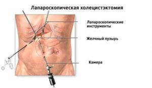 Боли после лапароскопии в правом боку