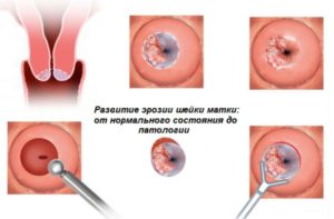Кровянистые выделения после швов на шейке матки при беременности