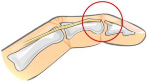 Закрытый отрыв сухожилия от ногтевой фаланги пальца