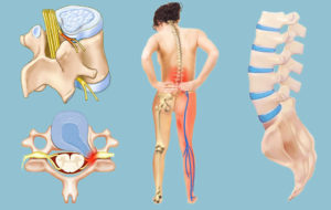 Межпозвоночная грыжа, боли в ноге