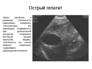 Стенки желчных протоков повышенной эхогенности