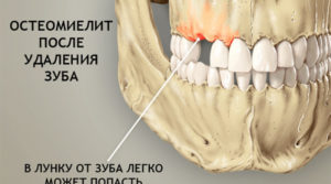Оголение челюстной кости, удаление зуба