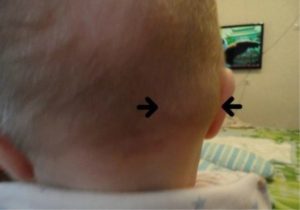 Увеличение лимфоузлов на голове у ребенка