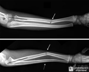 Перелом предплечья, локтевой и лучевой кости у ребенка 8 лет