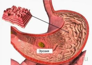 Эффективна ли замена кардимагнила на клопидогрель при эрозии желудка