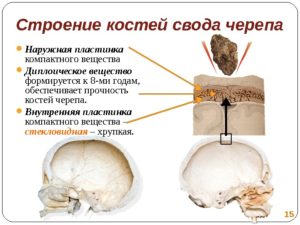 Периостит наружной кортикальной пластинки костей свода черепа