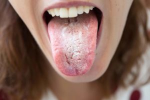 Дисбактериоз, обложен язык