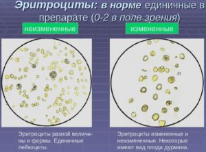 Эритроциты в моче от аллергии