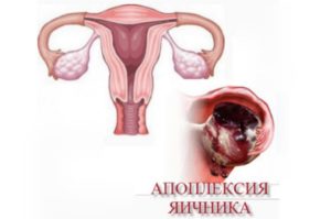 Беременность после апоплексии яичника