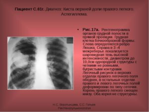 Единичное мелкое солитарное образование нижней доли левого лёгкого