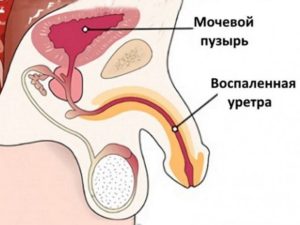 Жжение в уретре После антибиотиков