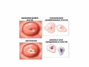 Образование на шейке матки ввиде прыщика
