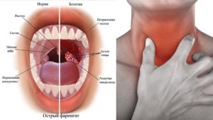 Болит горло внутри