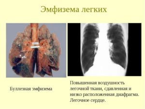 Эмфизема легких