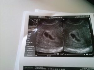 Боли в животе при беременности 6 недель