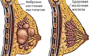 Диффузная фиброзно-кистозная мастопатия