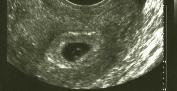 Почему узи не видит плодного яйца