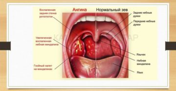 Образования на задней стенки горла Образования на задней стенки горла
