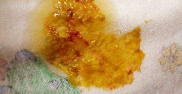 Скрытая кровь в кале, дисбактериоз