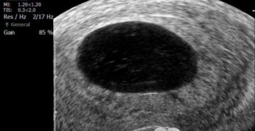 Анэмбриония. Сколько ждать?