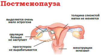 Обострение остеохондроза при менструации или женские гормоны бушуют?