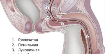 Расширение наружного отверстия уретры