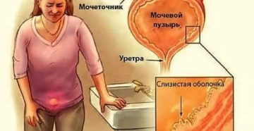 Боль при беременности в мочевом пузыре