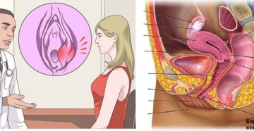 Бартолиновая железа или рак?
