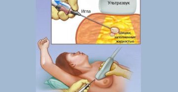 Удаление фиброаденом молочной железы без предварительной биопсии?