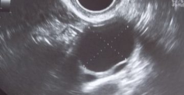 Свободная жидкость в правом яичнике