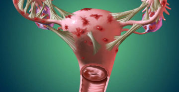 Эндометриоз, эндометриома