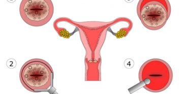 Месячные после конизации