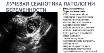 Эмбрион не лоцируется Эмбрион не лоцируется