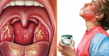 Чем можно снимать налеты при хроническом тонзиллите? Чем можно снимать налеты при хроническом тонзиллите?