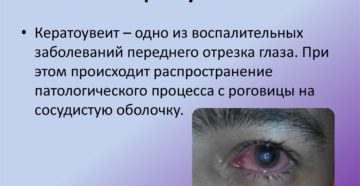 Кератоувеит