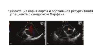 Дилатация восходящей аорты у ребенка