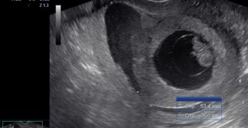 Ретрохориальная гематома при беременности на ранних сроках 8 недель Ретрохориальная гематома при беременности на ранних сроках 8 недель