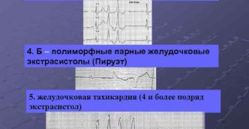 Мономорфные желудочковые экстрасистолы