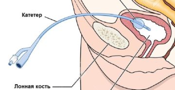 Как начать самостоятельно мочиться после цистотомы