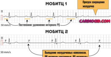 АВ блокады 2 ст. Тип 1 у ребенка, занимается спортом