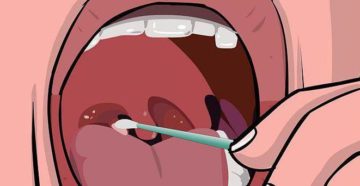 Белые точки на миндалинах Белые точки на миндалинах