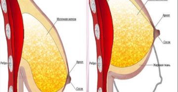 Уменьшение груди после ГВ