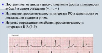 Миграция водителя ритма