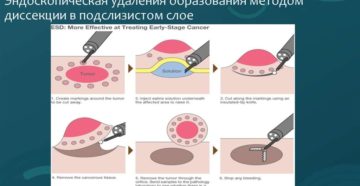 Эндоскопическая диссекция в подслизистом слое