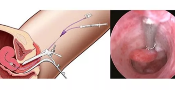Гиперплазия эндометрия, фолликулярная киста, перименопауза, выскабливание