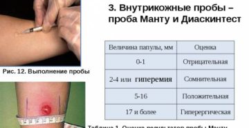 Диаскин тест при внелегочной форме туберкулеза