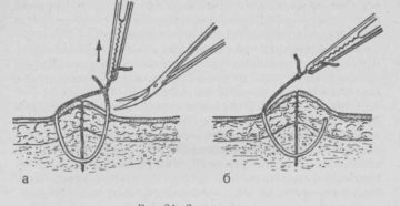 Когда снимать швы после пореза