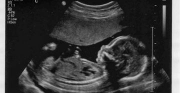 На 20 неделе беременности генерализованный отек и анемия у плода