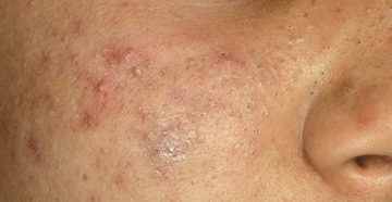 Киста и прыщи