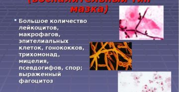 Воспалительный тип мазка